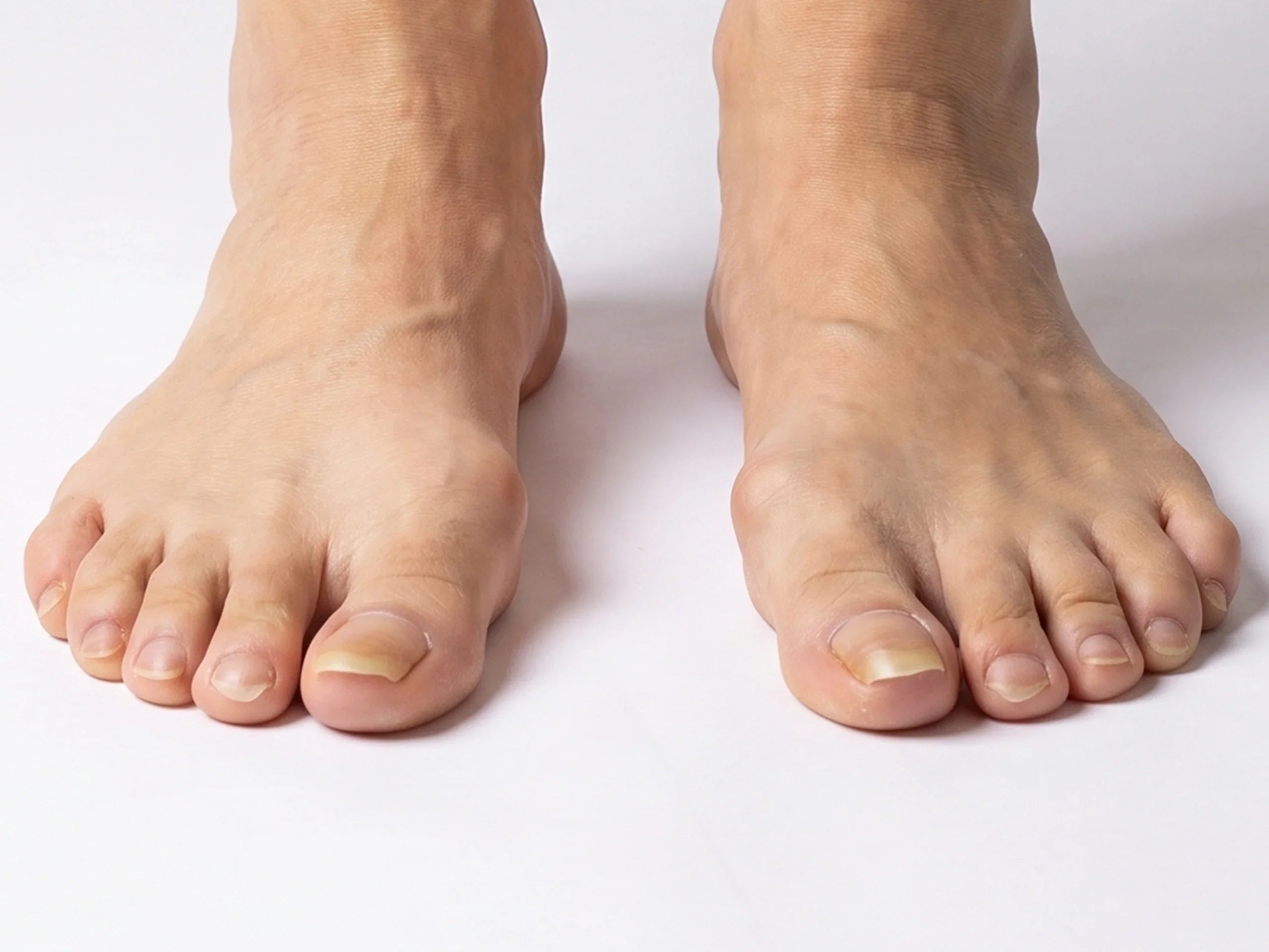Before-and-after comparison showing how German toenail clippers transform thick discolored toenails into cleanly trimmed healthy-looking nails